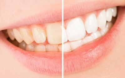 Tout savoir sur le blanchiment dentaire américain