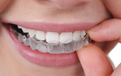 Tout savoir sur les aligneurs dentaires Invisalign